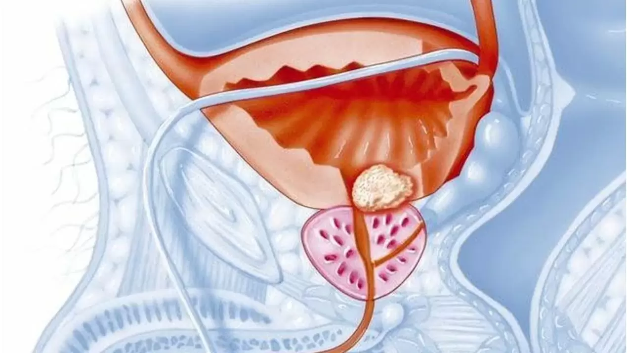 choroba prostaty u mężczyzn