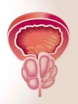 Zapalenie prostaty